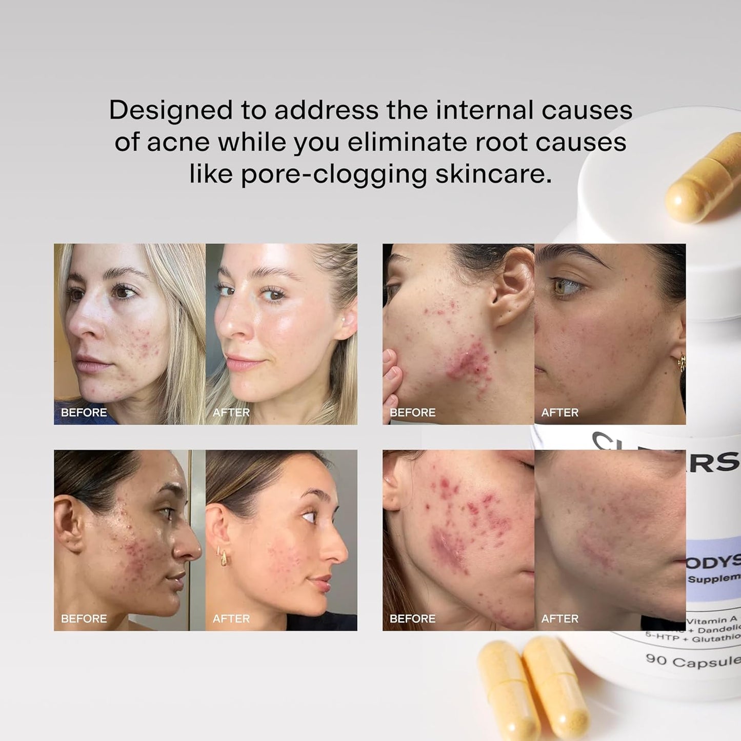 MINDBODYSKIN Hormonal Acne Supplement